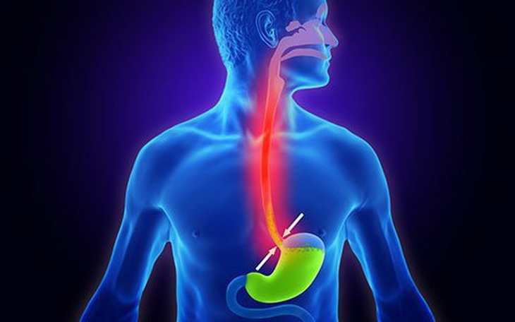 Bí quyết ăn uống giúp giảm bớt những phiền toái do chứng ợ chua