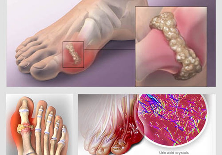 Bệnh gout: Nguyên nhân, phân loại và cách điều trị - Ảnh 1.