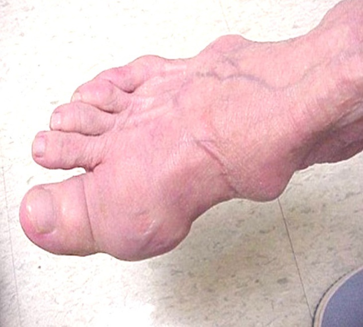 Bệnh gout cấp: Biểu hiện, diễn biến và những lưu ý khi thời tiết lạnh - Ảnh 4.