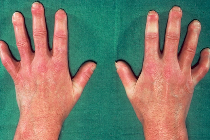 Điều trị hội chứng Raynaud - Ảnh 1.