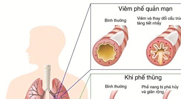 Viêm phế quản cấp thường là một phần của nhiễm trùng đường hô hấp trên xảy ra ở những bệnh nhân không có các bệnh phổi mãn tính. Nguyên nhân hầu hết là do nhiễm virus.