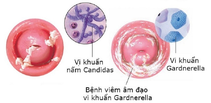 Điều trị viêm âm đạo do tạp khuẩn - Ảnh 1. Điều trị viêm âm đạo do tạp khuẩn - Ảnh 1.