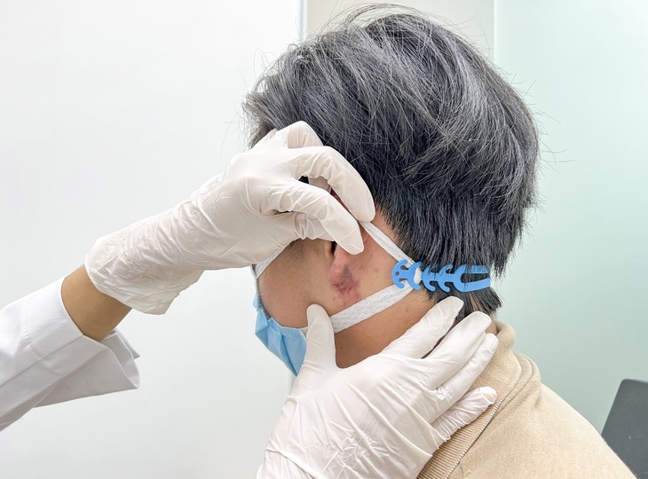 Nam thanh niên bị loét hoại tử do tiêm filler tạo tai Phật - Ảnh 1. Nam thanh niên bị loét hoại tử do tiêm filler tạo tai Phật - Ảnh 1.