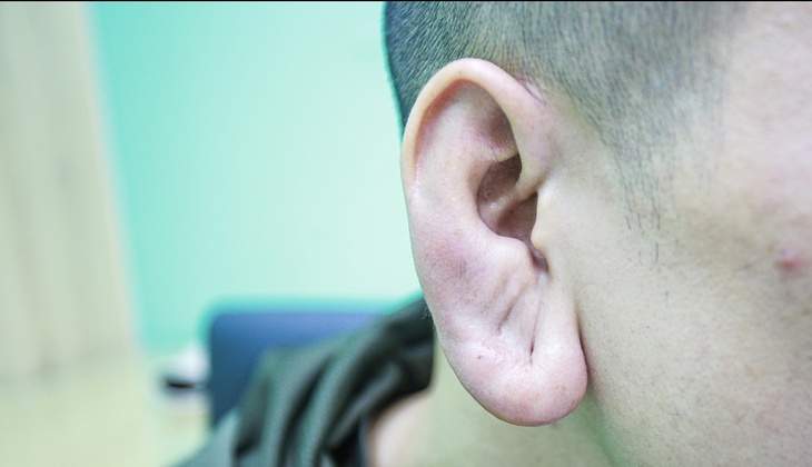 Nam thanh niên bị loét hoại tử do tiêm filler tạo tai Phật - Ảnh 3. Nam thanh niên bị loét hoại tử do tiêm filler tạo tai Phật - Ảnh 3.