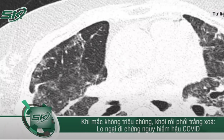 Nguy cơ phổi trắng xóa hậu COVID-19 dù là F0 không triệu chứng
