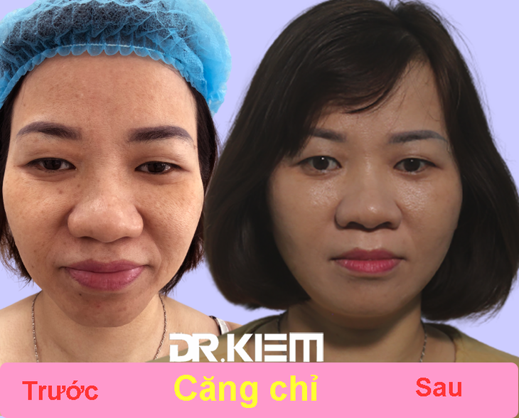 Căng chỉ da mặt giúp trẻ hóa khuôn mặt - Ảnh 1.