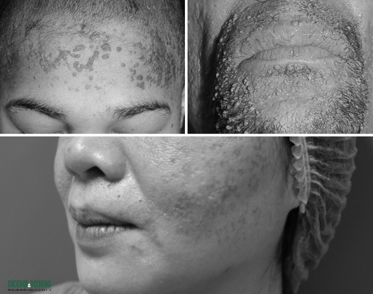 Laser màu xung - kỹ thuật cao, mới trong điều trị hạt cơm phẳng  - Ảnh 1.