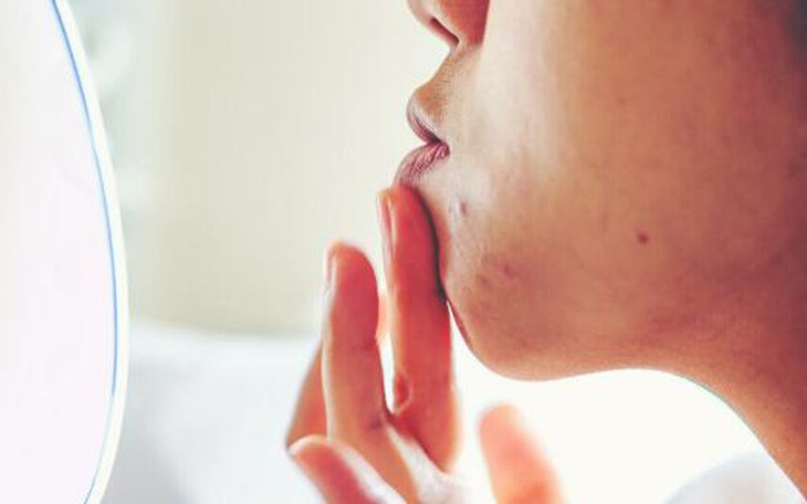 Uống sữa có gây mụn không?