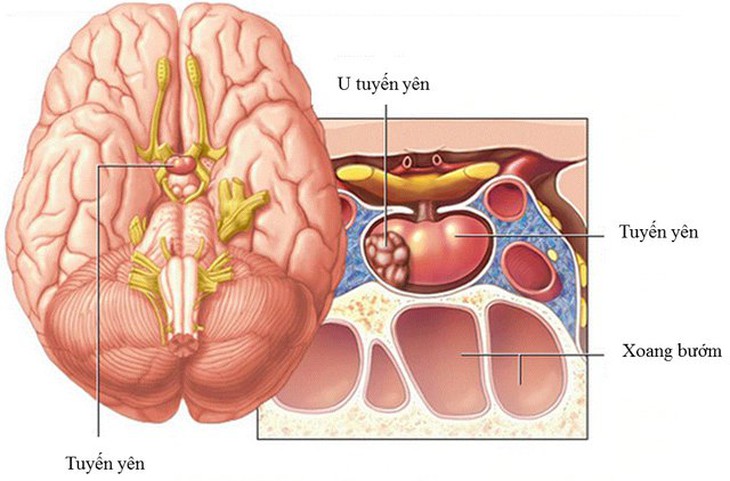 Đau đầu, đau buốt ở tay, chân và to lên bất thường… cảnh giác với bệnh to đầu chi - Ảnh 3. Đau đầu, đau buốt ở tay, chân và to lên bất thường… cảnh giác với bệnh to đầu chi - Ảnh 3.