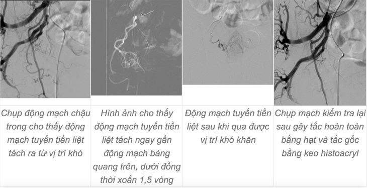 Lập nhiều kỳ tích, nâng tầm y học Việt nhờ kỹ thuật cao trong can thiệp điện quang - Ảnh 5. Lập nhiều kỳ tích, nâng tầm y học Việt nhờ kỹ thuật cao trong can thiệp điện quang - Ảnh 5.
