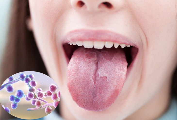 Các bệnh thường gặp do nấm Candida - Ảnh 2. Các bệnh thường gặp do nấm Candida - Ảnh 2.