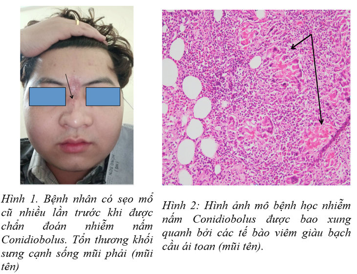 Loại nấm gây biến dạng mặt, sưng nề mũi, má - Ảnh 1. Loại nấm gây biến dạng mặt, sưng nề mũi, má - Ảnh 1.