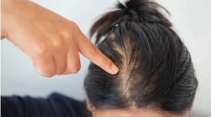 Rụng tóc 2