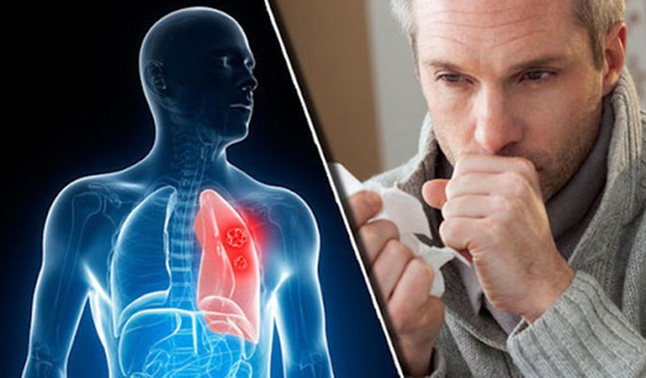 Ho ra máu do ung thư: Cách nhận biết và những lưu ý - Ảnh 3.