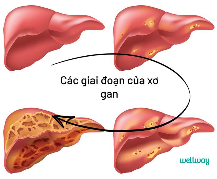 5 dấu hiệu cảnh báo gan của bạn đang nhiễm độc, 6 điều gan "sợ" nhất, nếu không muốn bệnh cần tránh xa - Ảnh 2. 5 dấu hiệu cảnh báo gan của bạn đang nhiễm độc, 6 điều gan "sợ" nhất, nếu không muốn bệnh cần tránh xa - Ảnh 2.
