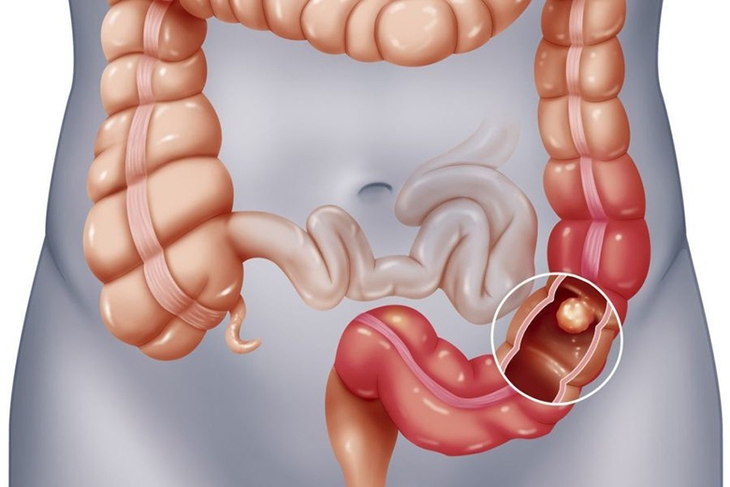 Polyp đại tràng có nguy hiểm? - Ảnh 2.