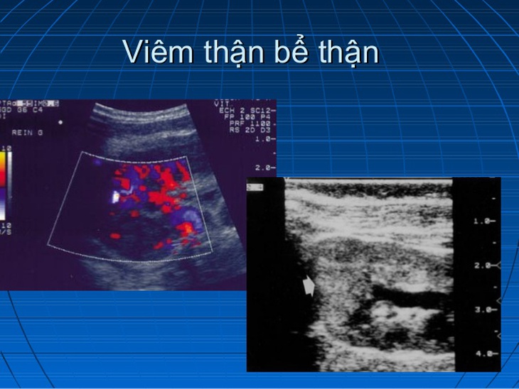 Viêm thận bể thận cấp: Nhận biết, nguyên nhân và điều trị - Ảnh 1.