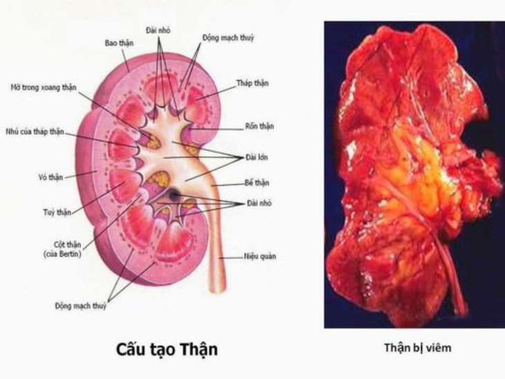 Viêm thận bể thận cấp: Nhận biết, nguyên nhân và điều trị - Ảnh 2.