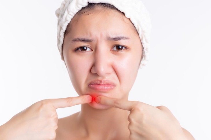 Mụn đinh râu: Nguyên nhân và triệu chứng - Ảnh 1.