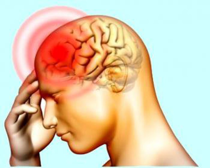 Đau đầu: Nguyên nhân, biểu hiện và điều trị - Ảnh 3. Đau đầu: Nguyên nhân, biểu hiện và điều trị - Ảnh 3.