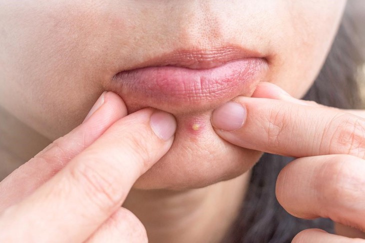 Mụn đinh râu: Nguyên nhân và triệu chứng - Ảnh 3.