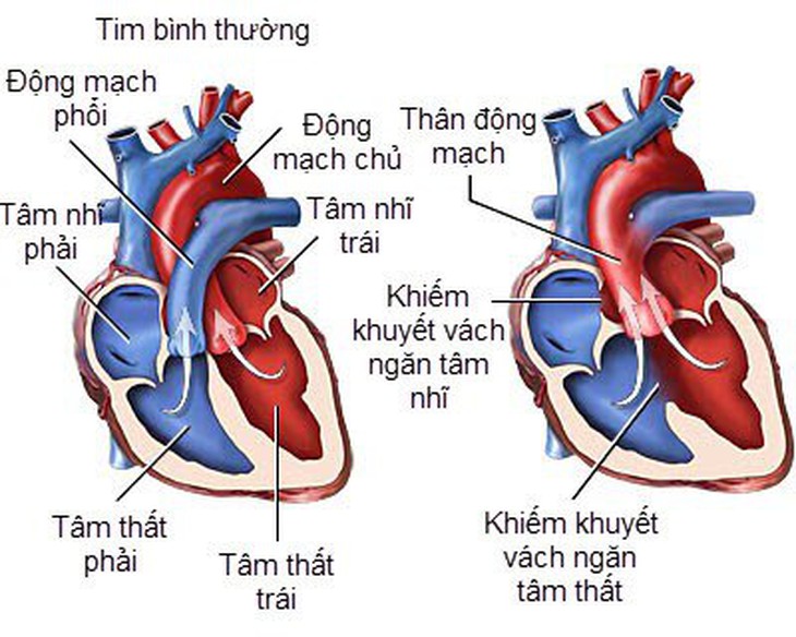 COVID-19 thể nặng đe dọa người mắc bệnh tim bẩm sinh ra sao? - Ảnh 5. COVID-19 thể nặng đe dọa người mắc bệnh tim bẩm sinh ra sao? - Ảnh 5.