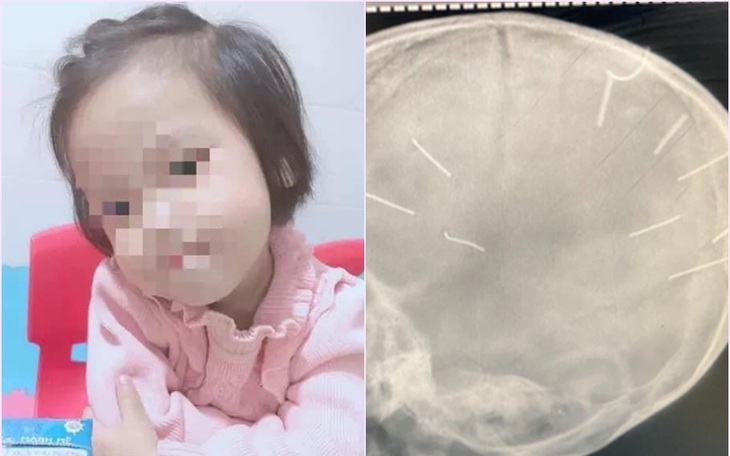 Bé gái bị đóng đinh vào đầu qua đời: "Mong con sống an yên nơi ấy!"