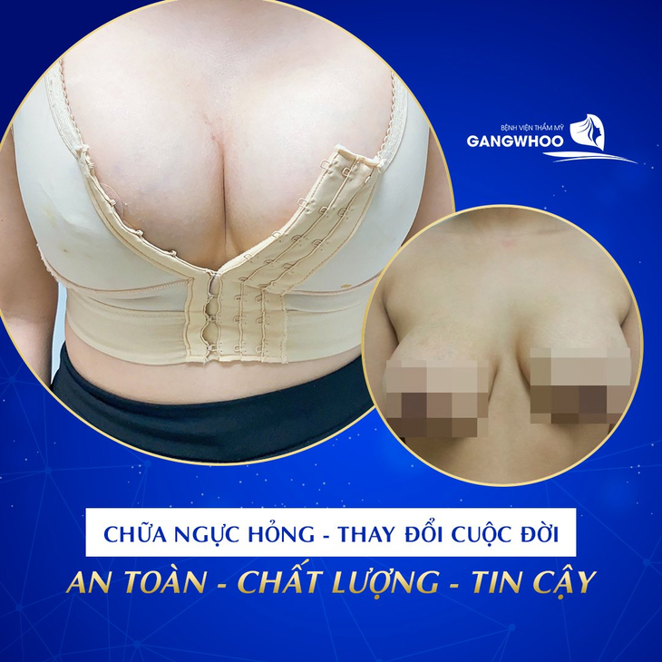 Sửa ngực hỏng uy tín, công nghệ Hàn Quốc BVTM Gangwhoo - Ảnh 2. Sửa ngực hỏng uy tín, công nghệ Hàn Quốc BVTM Gangwhoo - Ảnh 2.