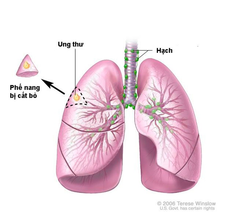 Ung thư phổi: Nguyên nhân, yếu tố nguy cơ gây bệnh và điều trị - Ảnh 1. Ung thư phổi: Nguyên nhân, yếu tố nguy cơ gây bệnh và điều trị - Ảnh 1.