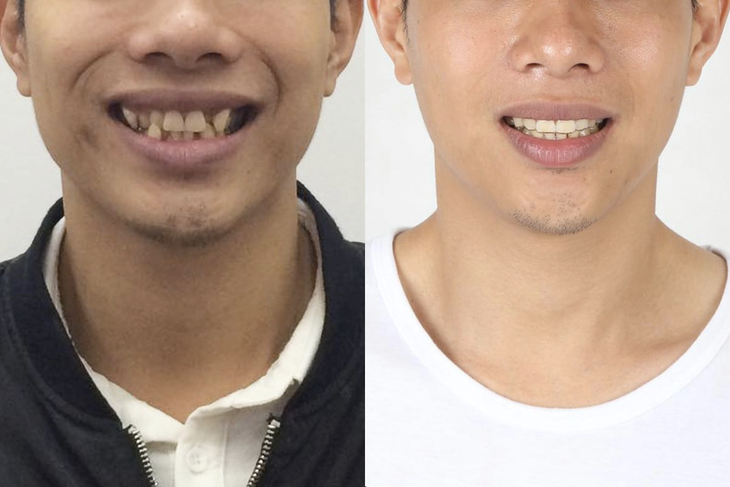 Bác sĩ Phan Trung Tiệp: Tôi muốn hướng tới một quy trình niềng răng "êm ái" hơn - Ảnh 2. Bác sĩ Phan Trung Tiệp: Tôi muốn hướng tới một quy trình niềng răng "êm ái" hơn - Ảnh 2.