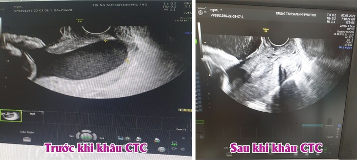 Bà bầu 21 tuần đã chuyển dạ, khẩn cấp khâu eo tử cung giữ thai - Ảnh 1. Bà bầu 21 tuần đã chuyển dạ, khẩn cấp khâu eo tử cung giữ thai - Ảnh 1.