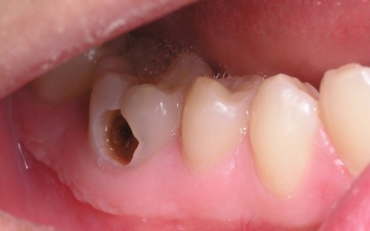 6 bài thuốc nam đơn giản, dễ kiếm chữa đau răng