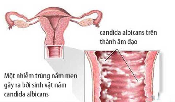 Sự khác biệt giữa nhiễm trùng tiết niệu và nhiễm trùng nấm  - Ảnh 4.