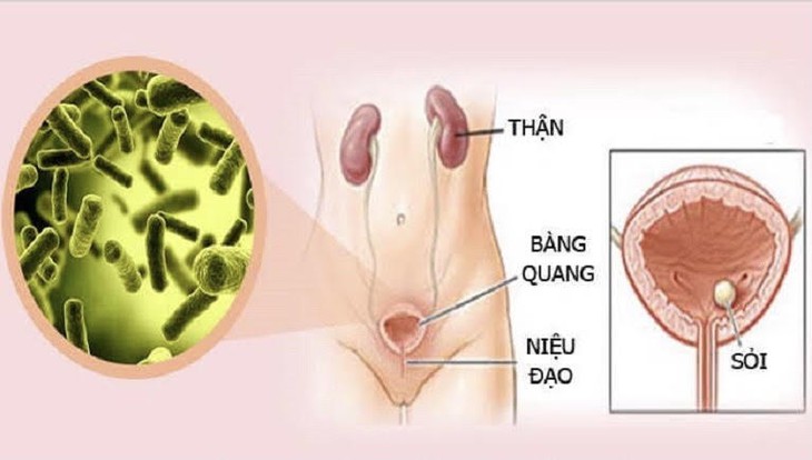Sự khác biệt giữa nhiễm trùng tiết niệu và nhiễm trùng nấm  - Ảnh 2.
