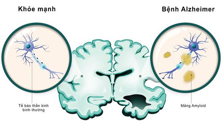 Bài thuốc hỗ trợ trị bệnh hay quên ở người cao tuổi - Ảnh 2.