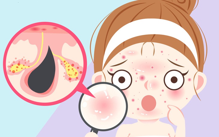 Nhận biết các loại mụn và cách chăm sóc da, "đánh bay" mụn tuổi dậy thì