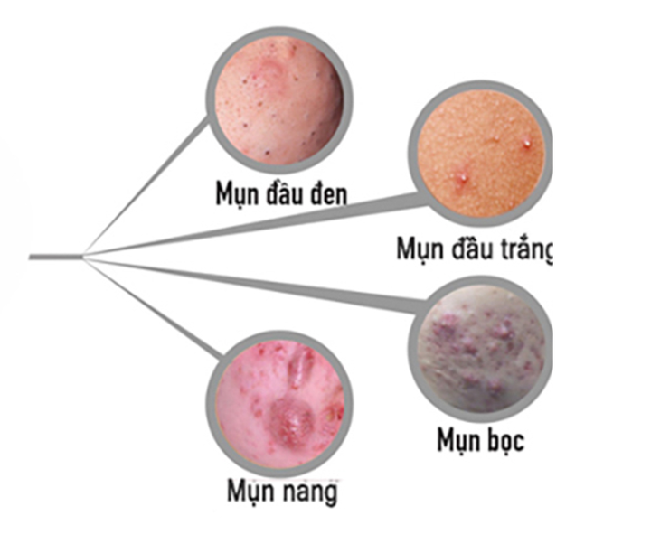 Mách các bạn trẻ dậy thì cách chăm sóc khi da mọc mụn  - Ảnh 4.