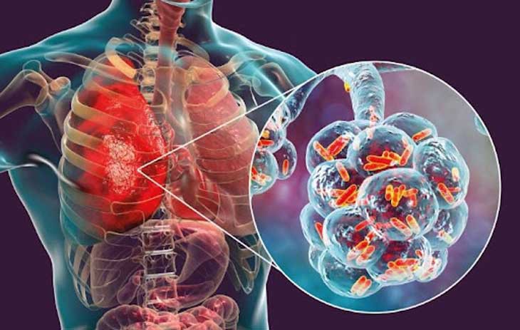 Cảnh giác viêm phổi do tụ cầu từ nhiễm khuẩn da - Ảnh 1. Cảnh giác viêm phổi do tụ cầu từ nhiễm khuẩn da - Ảnh 1.