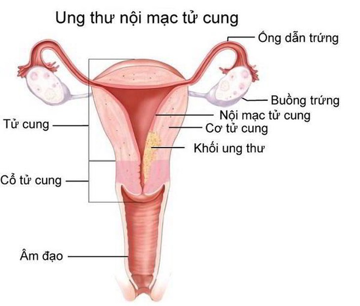 Ung thư nội mạc tử cung: Nguyên nhân, dấu hiệu và giai đoạn phát triển - Ảnh 1.