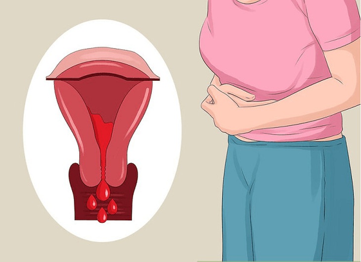Ung thư nội mạc tử cung: Nguyên nhân, dấu hiệu và giai đoạn phát triển - Ảnh 2.