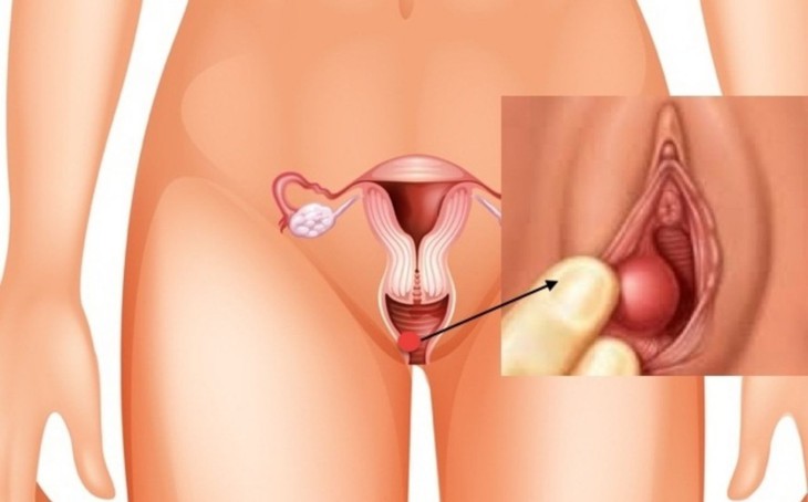 Áp xe tuyến Bartholin: Nguyên nhân, triệu chứng và cách điều trị - Ảnh 2. Áp xe tuyến Bartholin: Nguyên nhân, triệu chứng và cách điều trị - Ảnh 2.
