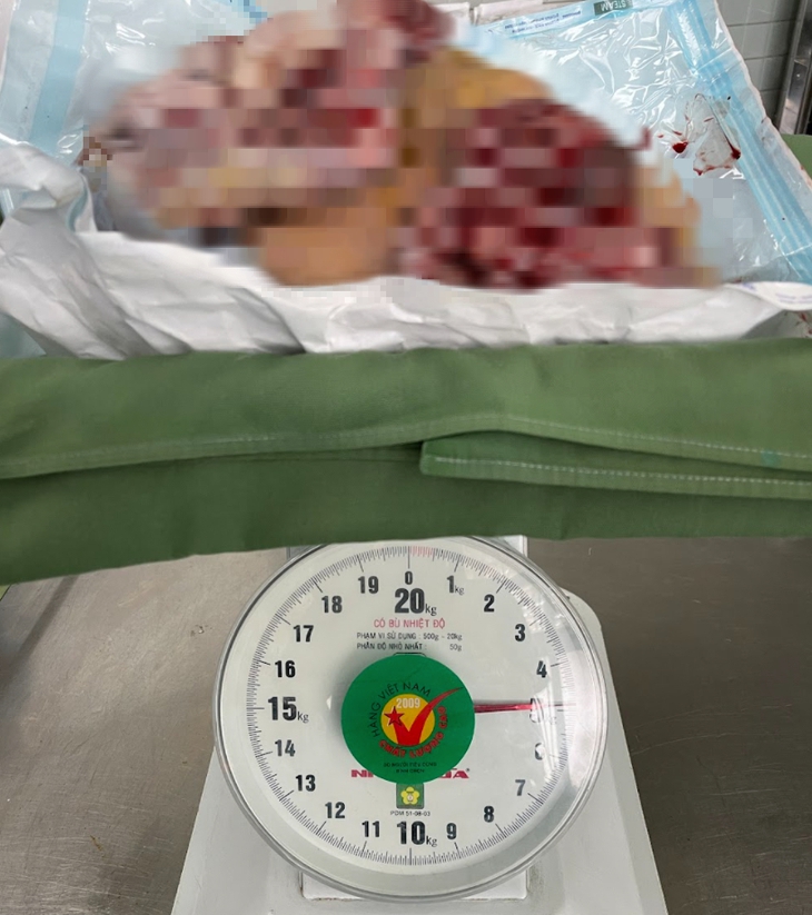 Người phụ nữ "đeo" khối u vú khổng lồ 5 kg - Ảnh 1.