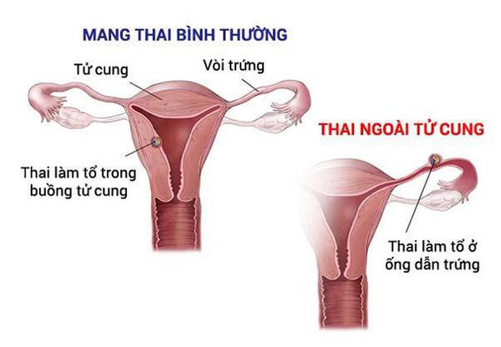 Các phương pháp điều trị vô sinh hiếm muộn và những tai biến có thể gặp phải  - Ảnh 6.