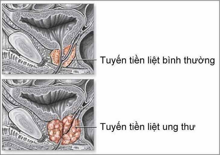 Ung thư tuyến tiền liệt những điều cần biết và hiểu lầm thường gặp - Ảnh 2.