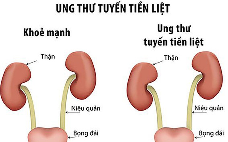 Ung thư tuyến tiền liệt và những hiểu lầm thường gặp