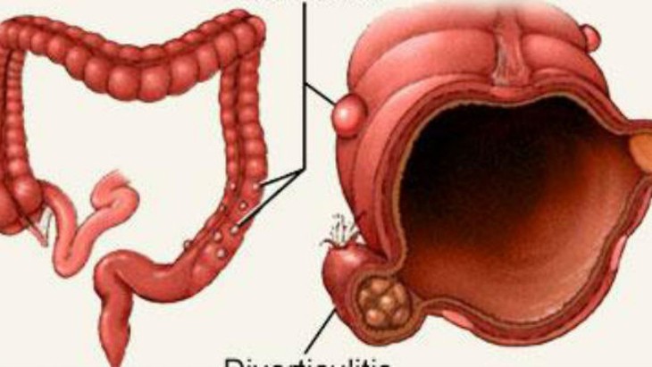 Đau bụng, nôn... cảnh giác với túi thừa Meckel biến chứng xuất huyết tiêu hóa - Ảnh 2.