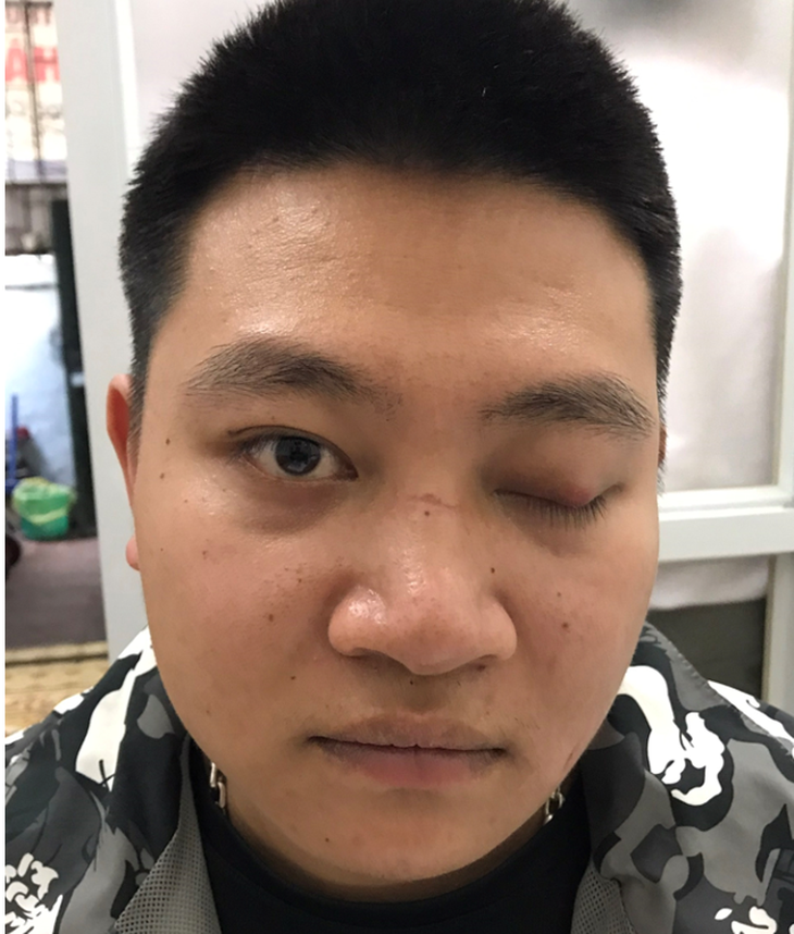Bênh sụp mí mắt: Nguyên nhân, triệu chứng và cách điều trị bằng Đông y - Ảnh 1.