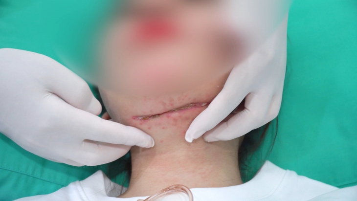 Cô gái phải cứa cổ vì hoại tử sau làm đẹp - Ảnh 1.