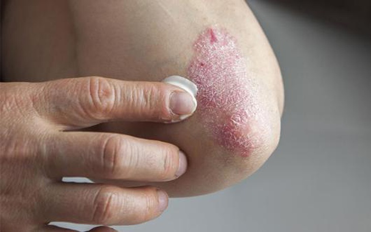Biện pháp trị bệnh vẩy nến