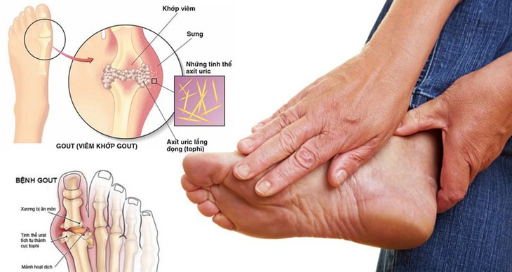 Bệnh gout được chữa như thế nào? - Ảnh 1.